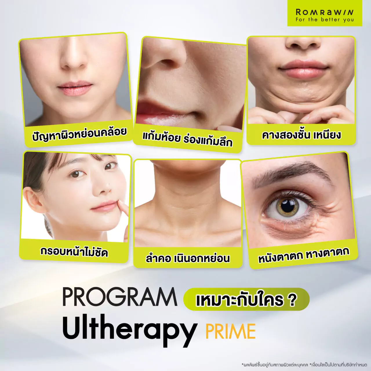 Ultherapy Prime เทคโนโลยียกกระชับที่โดดเด่นที่สุด 3 เทคโนโลยียกกระชับ Ultherapy Prime เหมาะกับใคร?