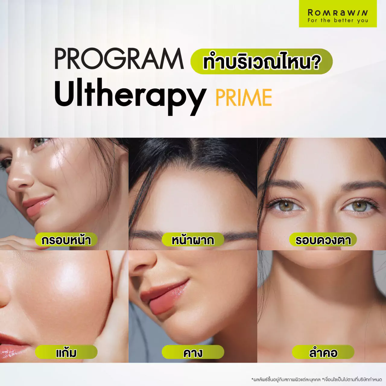 Ultherapy Prime เทคโนโลยียกกระชับที่โดดเด่นที่สุด 5 เทคโนโลยียกกระชับ Ultherapy Prime ทำบริเวณใดได้บ้าง?