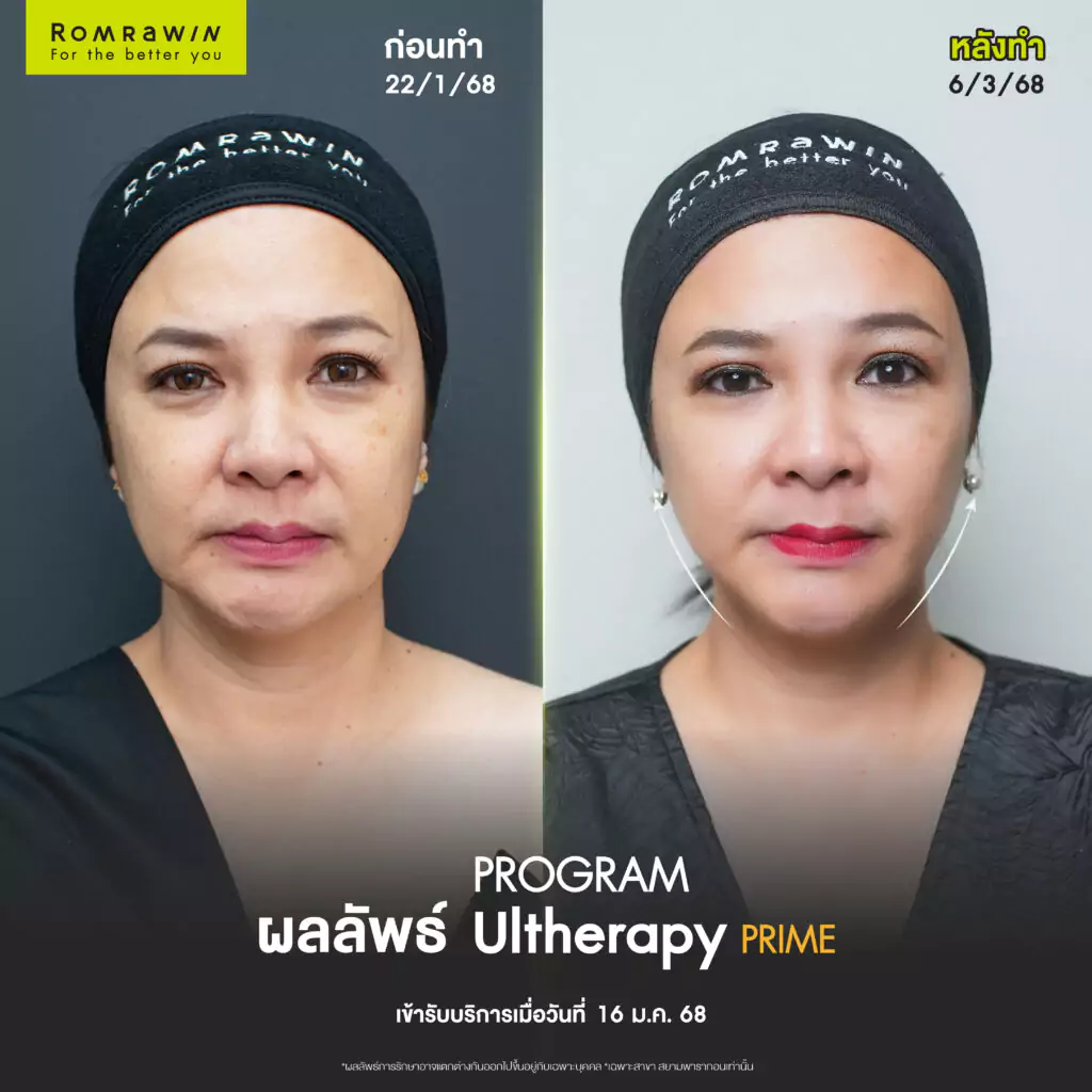 กีต้าร์ ศิริพิชญ์ ยกกระชับแบบลืมเจ็บ