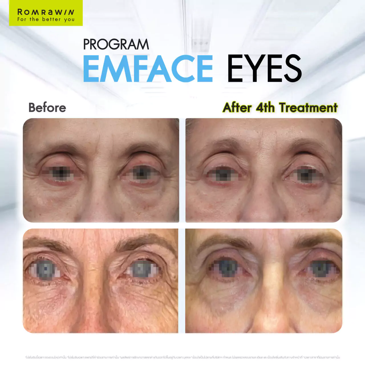 Emface Eyes ผสาน 2 เทคโนโลยีเพื่อผิวใต้ตาเฟิร์ม กระจ่างใส ดูอ่อนเยาว์ 8 Emface EYE