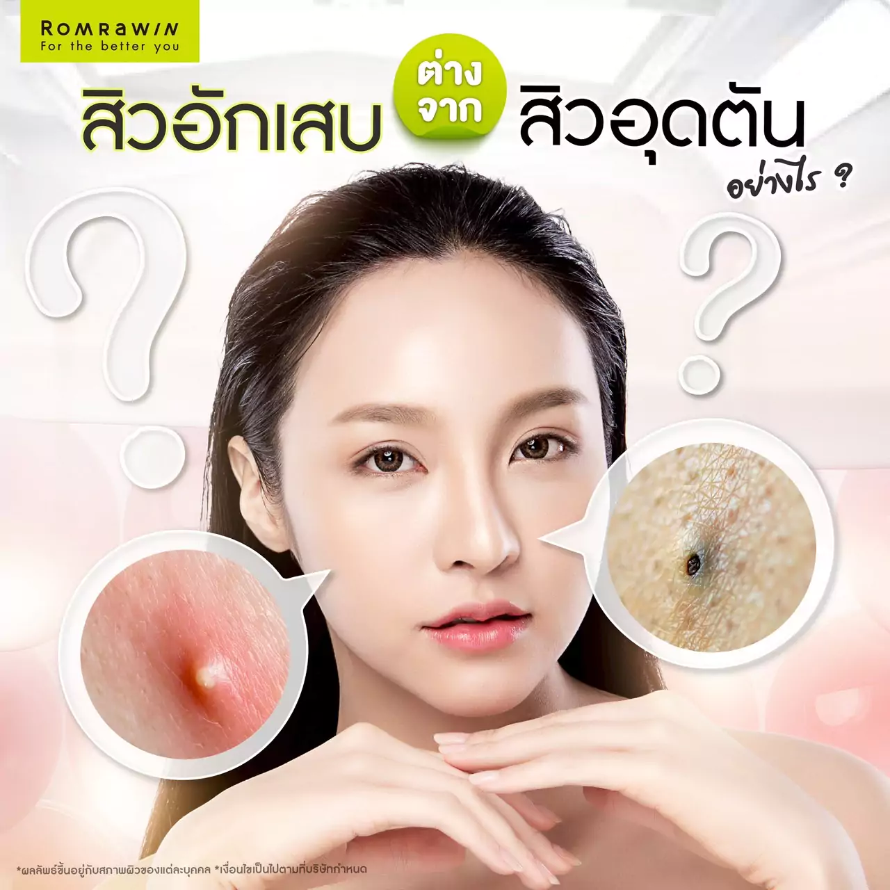 สิวอักเสบเกิดจากอะไร ? รวมคำถามเกี่ยวกับสิวอักเสบที่คุณไม่เคยรู้ 4 สิวอักเสบต่างจากสิวอุดตันยังไง ?