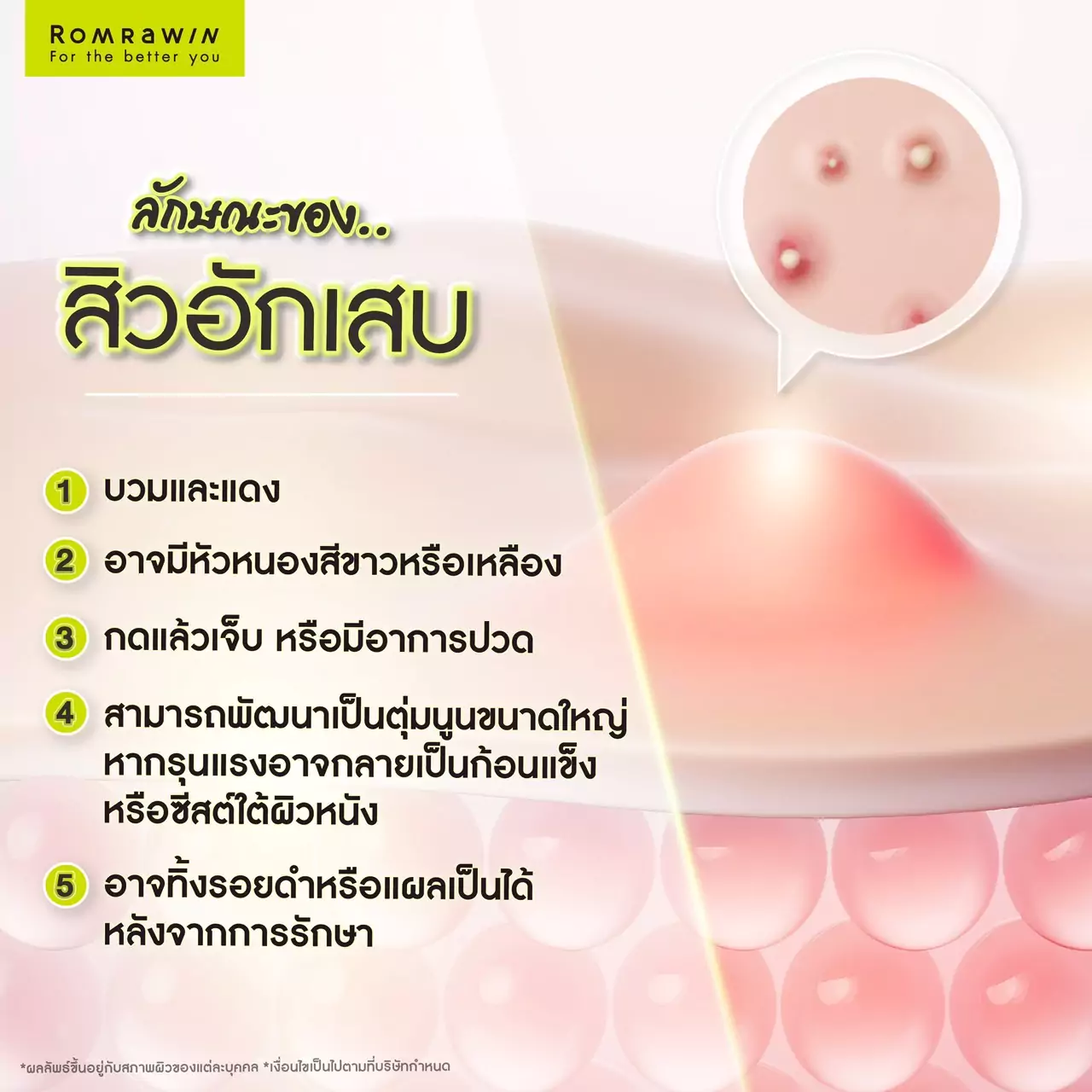 สิวอักเสบเกิดจากอะไร ? รวมคำถามเกี่ยวกับสิวอักเสบที่คุณไม่เคยรู้ 2 ลักษณะของสิวอักเสบ