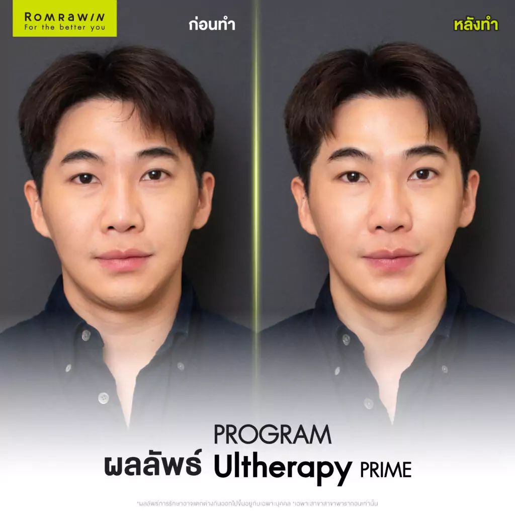 Ultherapy PRIME คุณเต๋า