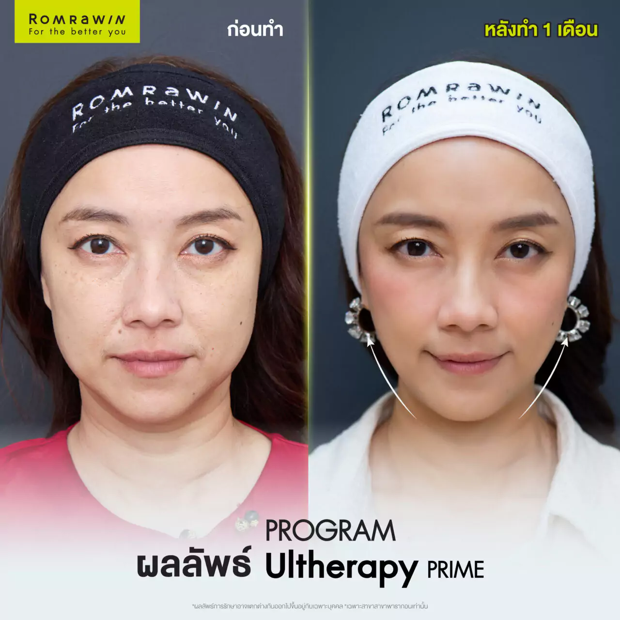 Ultherapy Prime คุณอ้อน ลัคนา