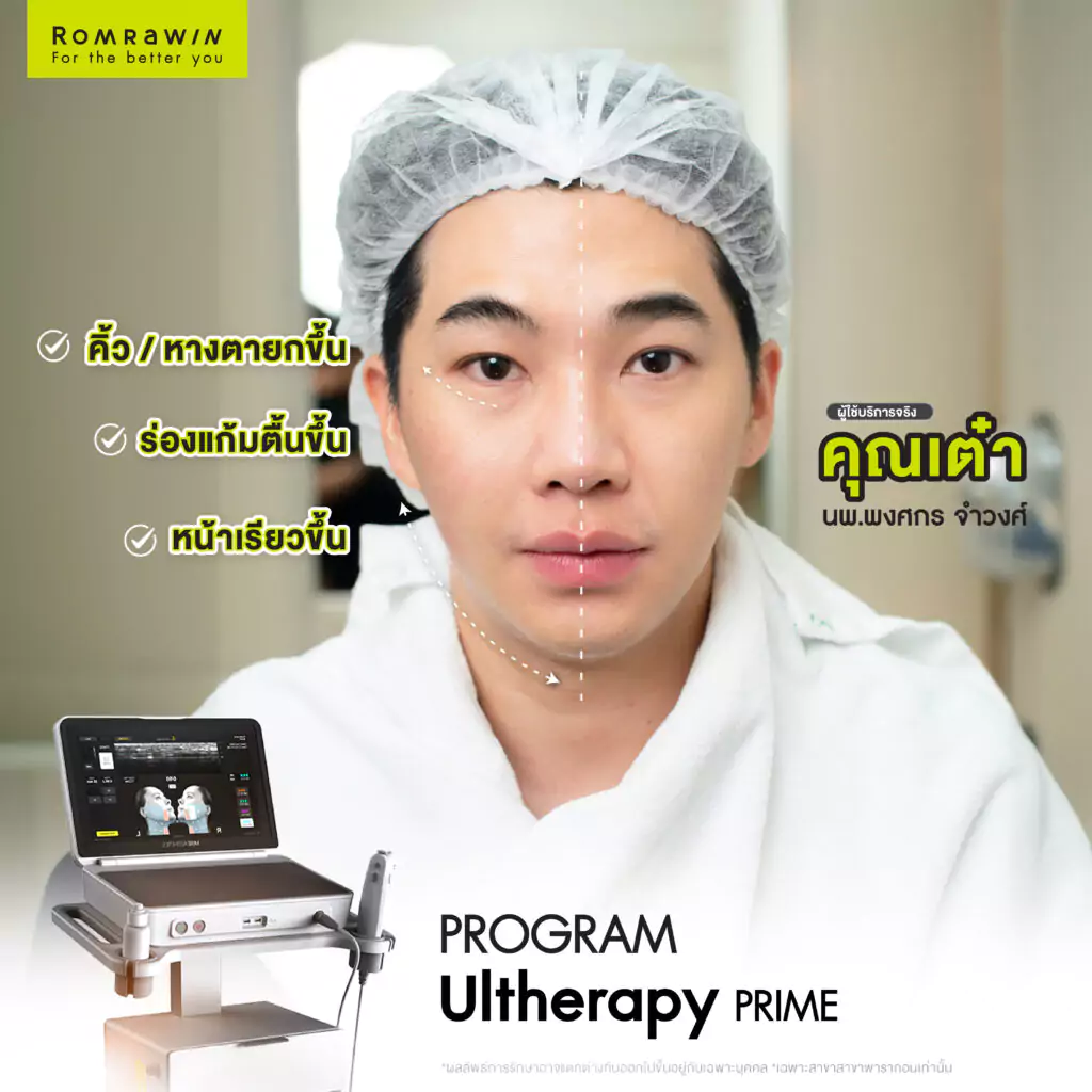 Ultherapy PRIME คุณเต๋า