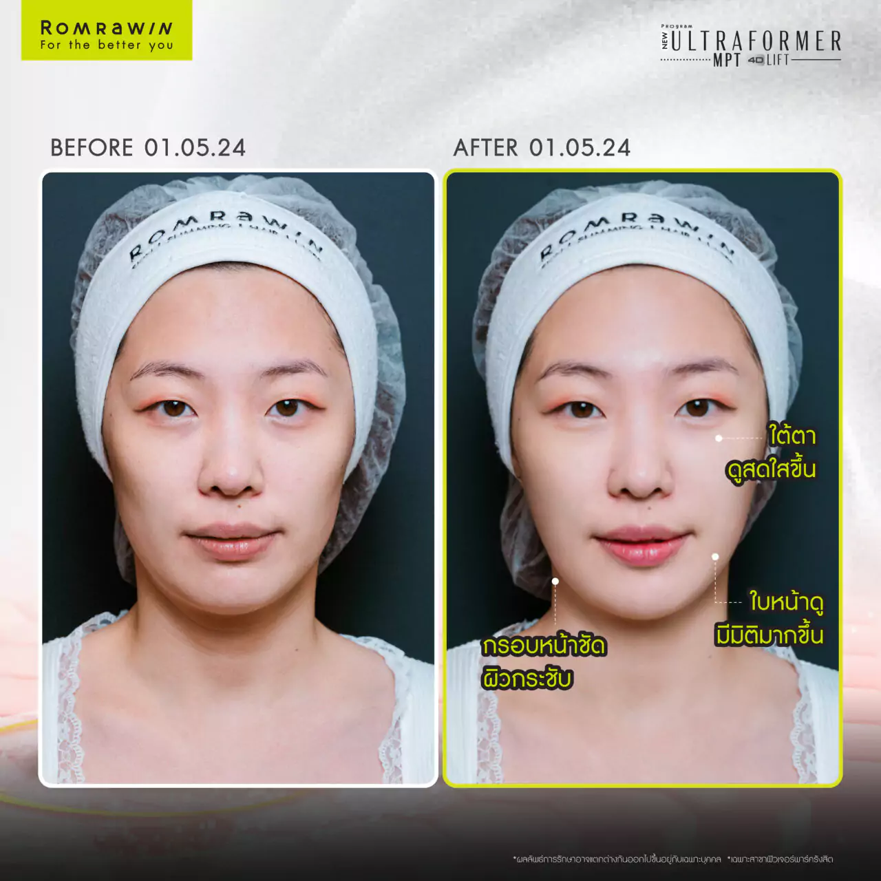 โปรแกรม Ultraformer MPT 4D LIFT ยกกระชับความหย่อนคล้อย 4 โปรแกรม Ultraformer MPT 4D LIFT ยกกระชับความหย่อนคล้อย