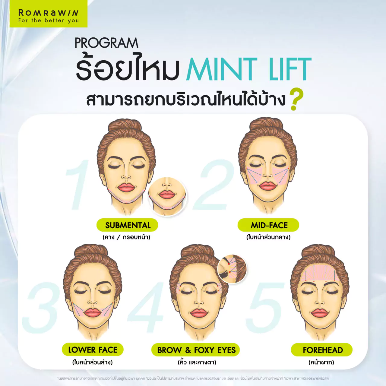 ไหม MINT Lift ไหมยกกระชับ ที่มอบผลลัพธ์การยกกระชับได้อย่างน่าพึงพอใจ 5 ร้อยไหม MINT Lift ยกบริเวณไหนได้บ้าง