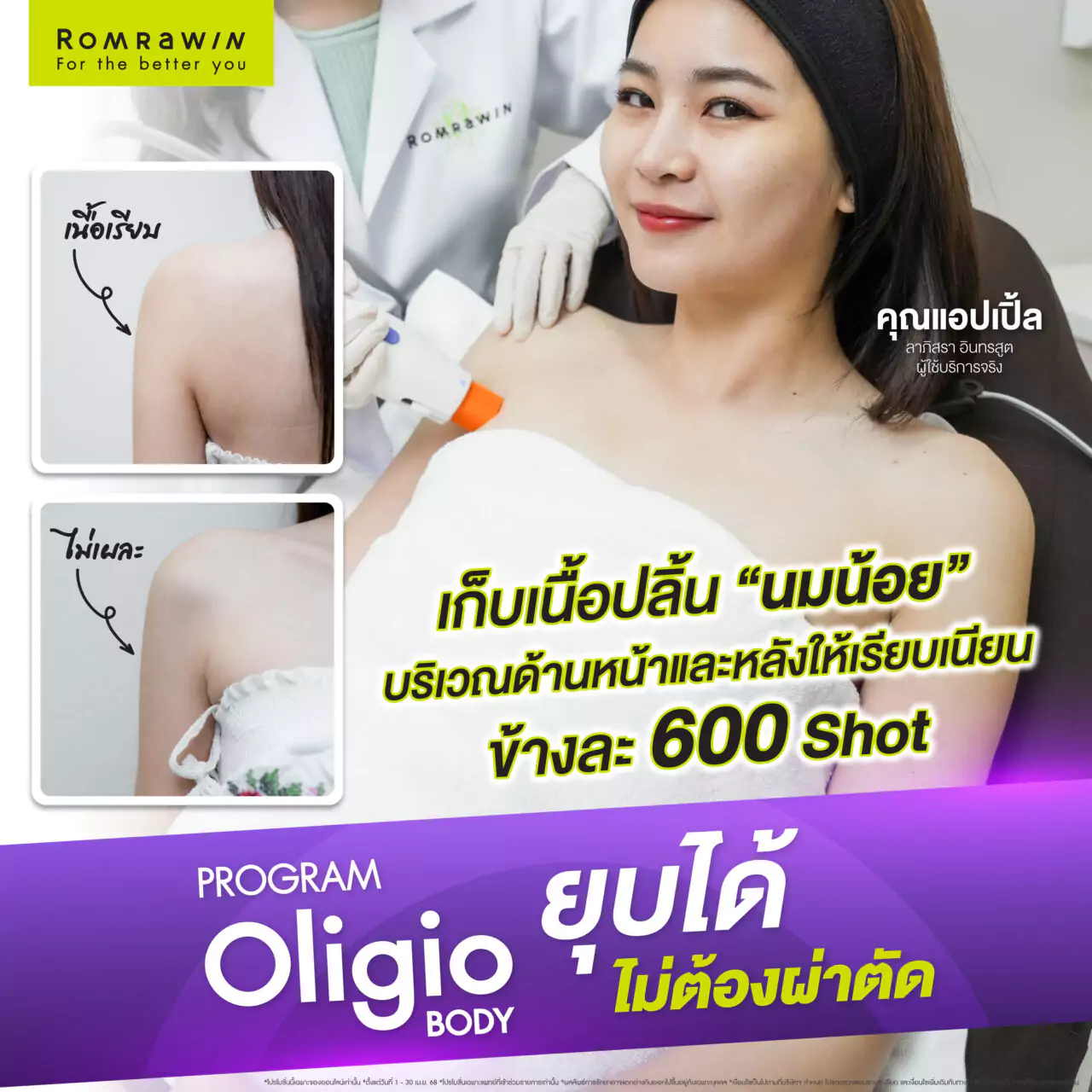 Oligio Body เลิกปลิ้น เปลี่ยนหุ่นให้เชพดี คุณแอปเปิ้ล ลาภิสรา