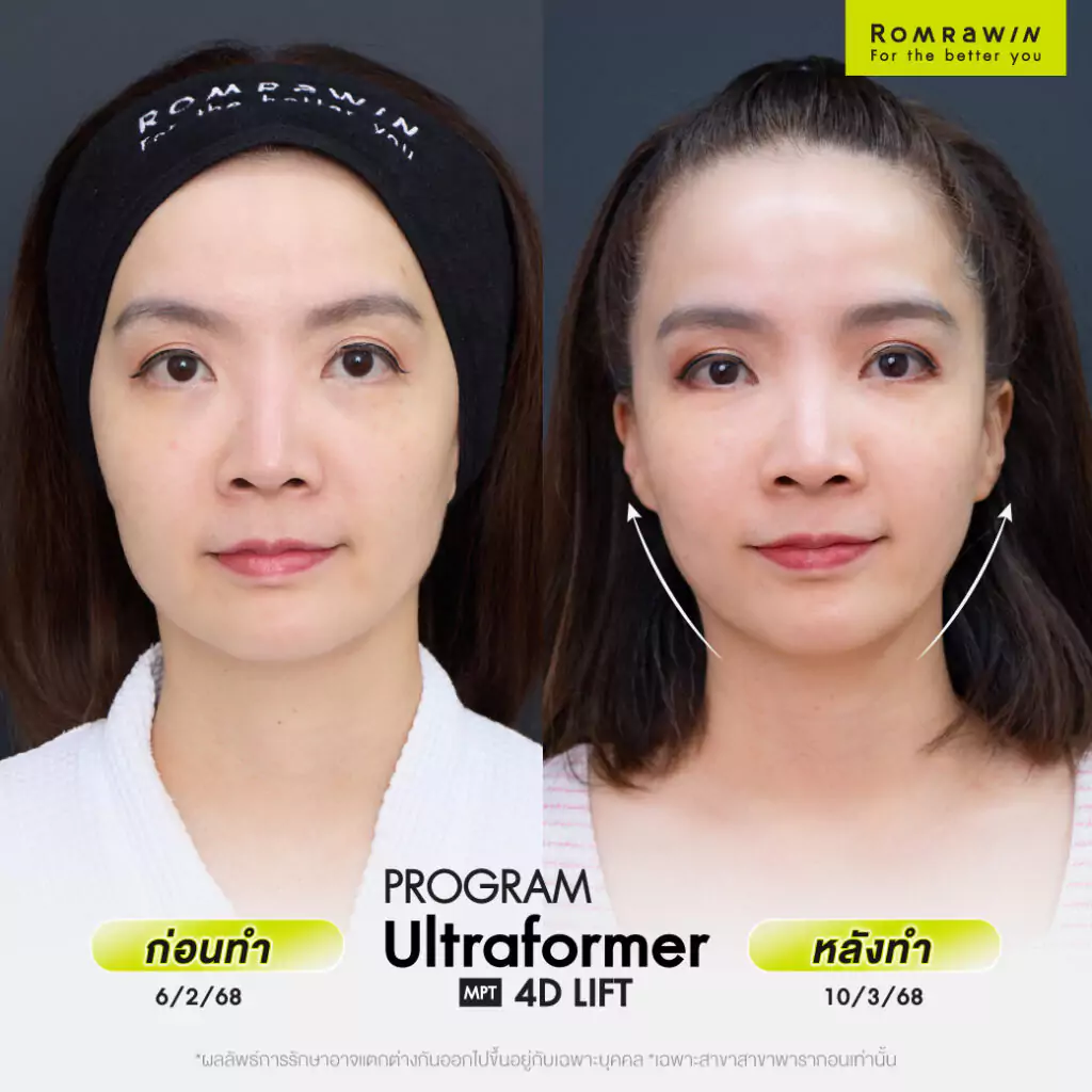 คุณหลี่แชเผยเคล็ดลับยกกระชับหน้า ดูดีทุกมุมจอด้วย Ultraformer MPT 4D LIFT