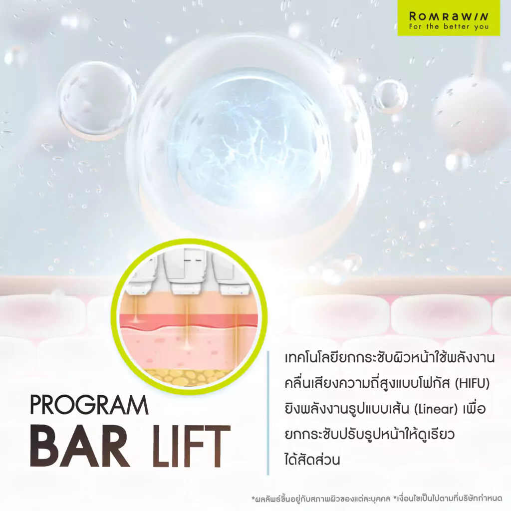 Bar Lift คืออะไร?