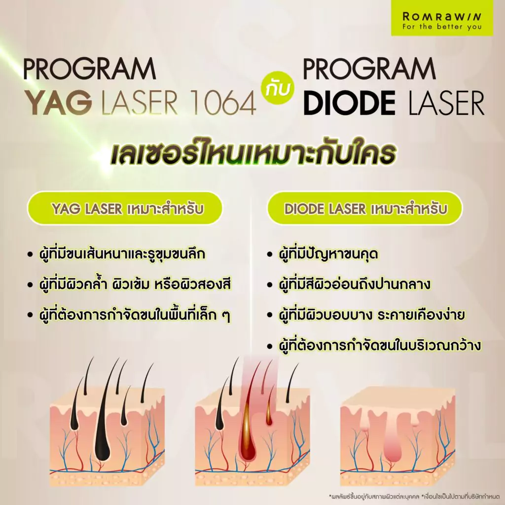 YAG Laser กับ Diode Laser เลเซอร์ไหนเหมาะกับใคร