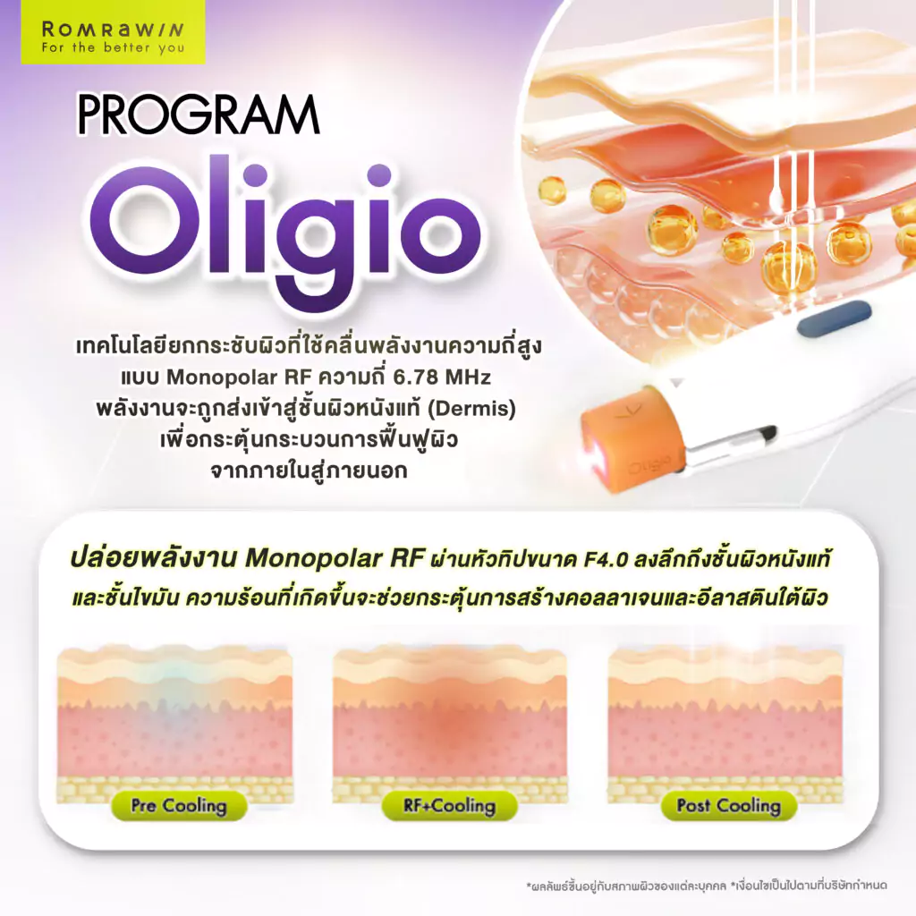รู้จัก Oligio ทางเลือกใหม่ของการยกกระชับผิวหน้า
