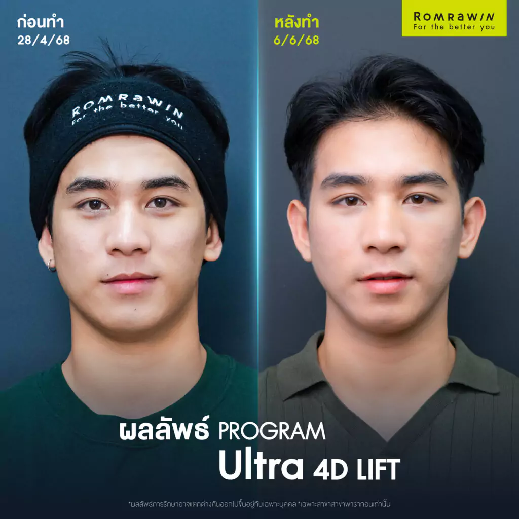 กรอบหน้าชัด Ultra 4D LIFT