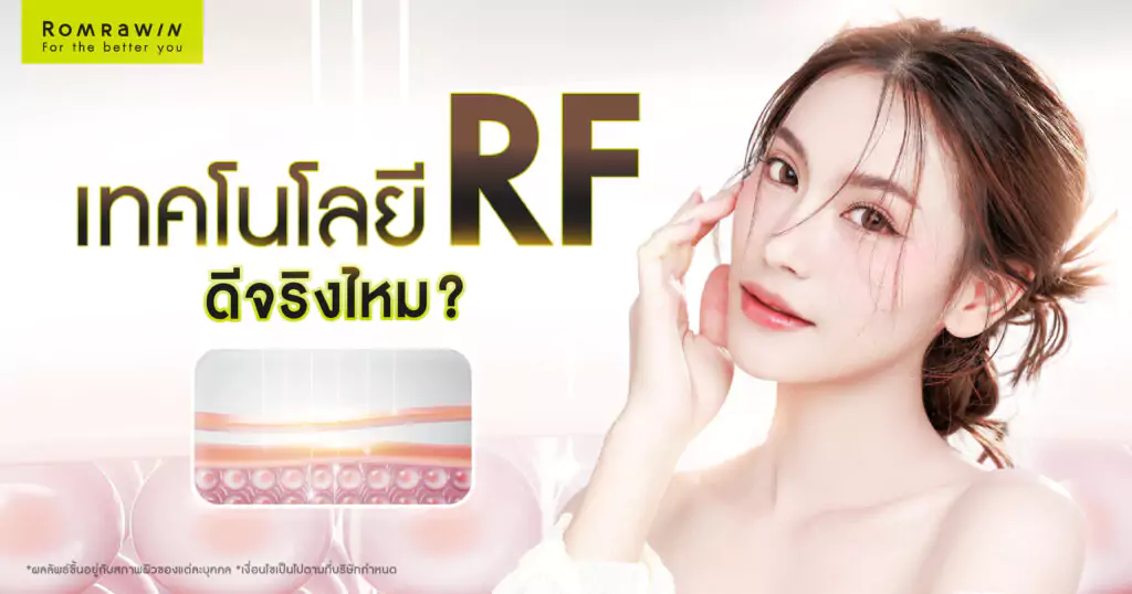 เทคโนโลยี RF (Radio Frequency)