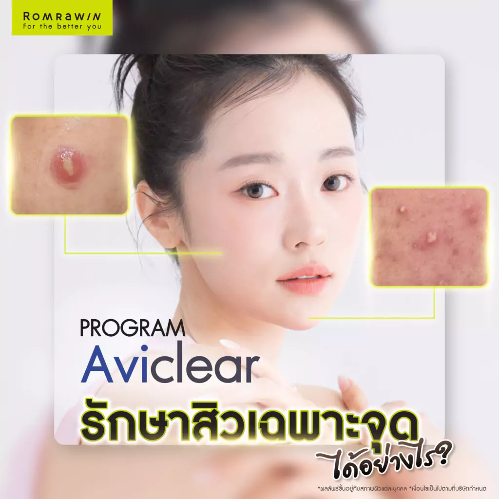 Aviclear รักษาสิวเฉพาะจุดได้อย่างไร ?