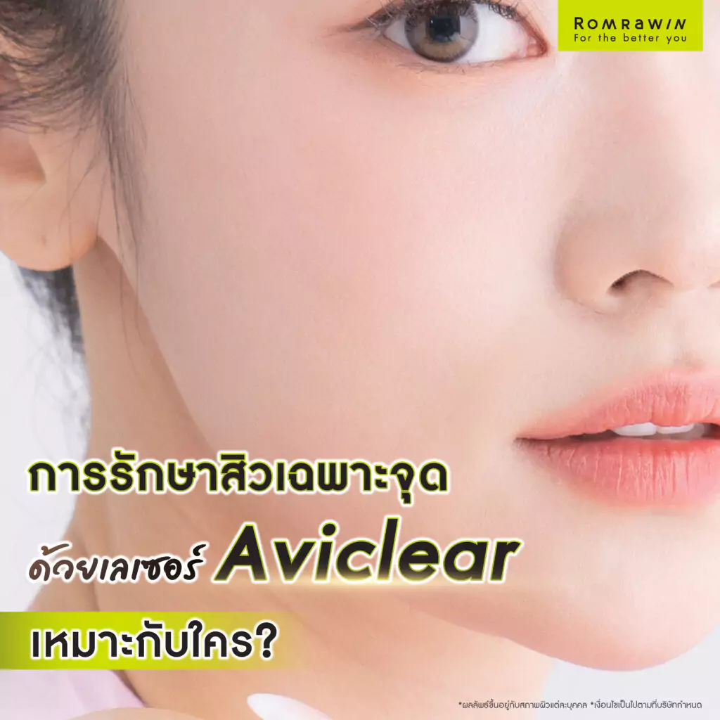 การรักษาสิวเฉพาะจุดด้วยเลเซอร์ Aviclear เหมาะกับใคร ?
