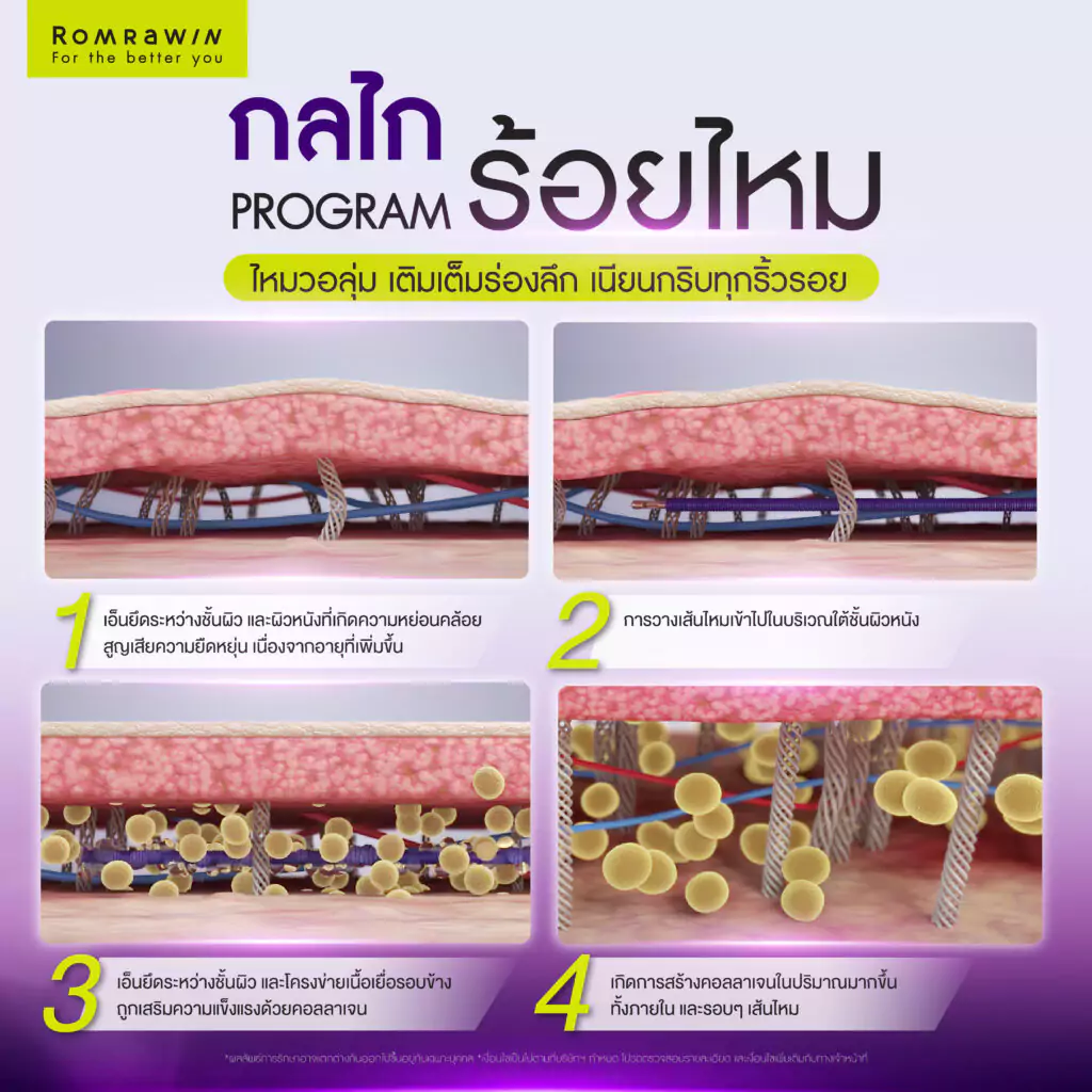 กลไกของการร้อยไหม