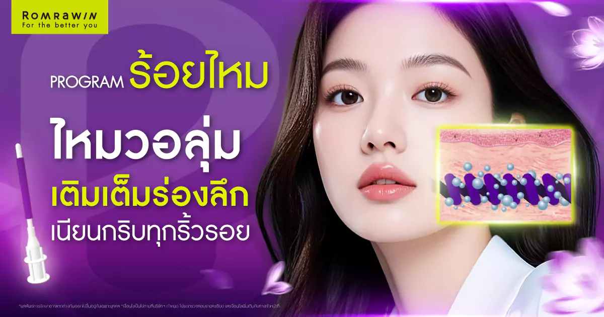 ไหม Epiticon