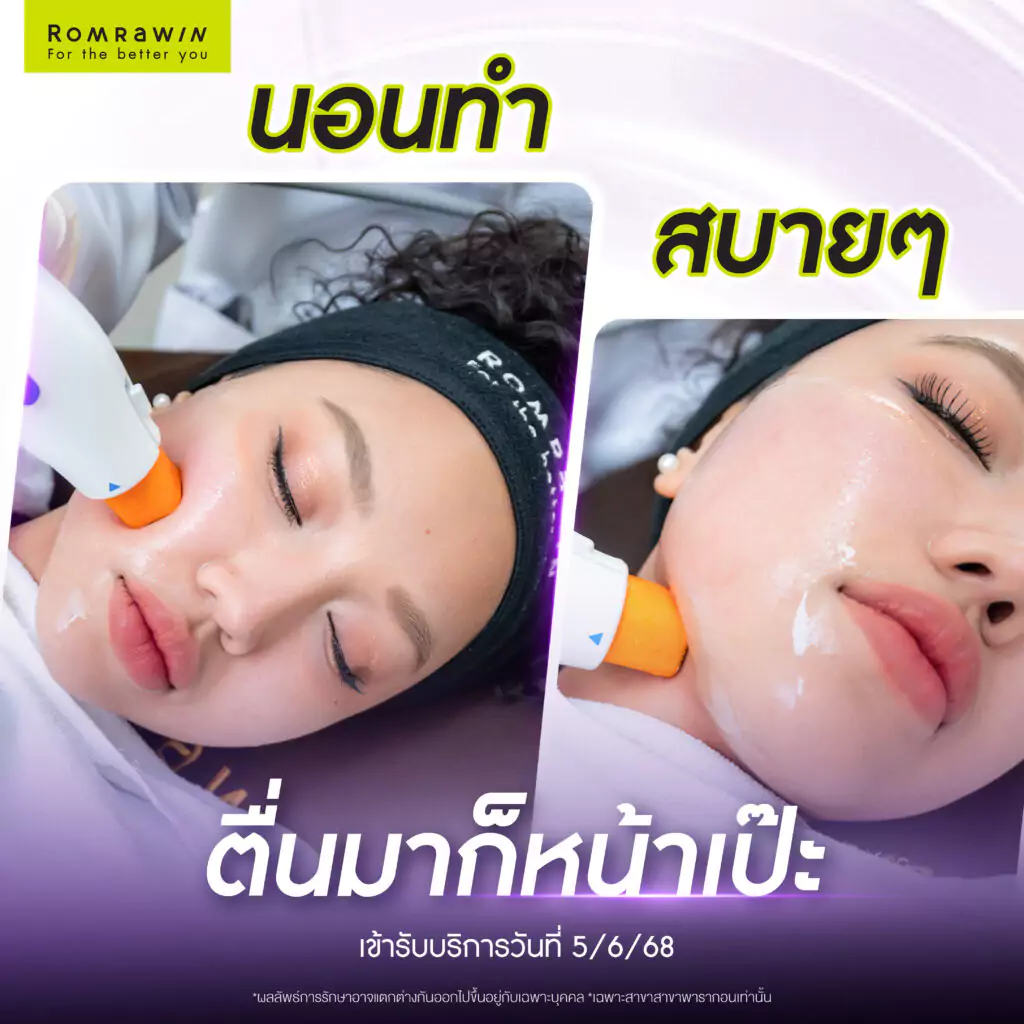 ยุบแก้มป่อง หน้าเรียวเหนียงหาย ไม่ต้องพึ่ง Contour  โดยคุณกีตาร์