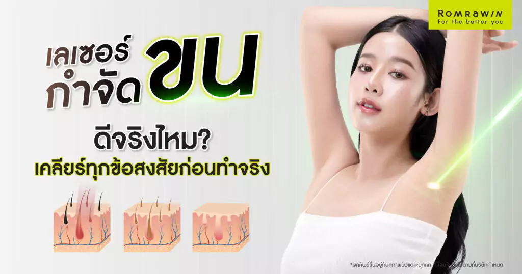 เลเซอร์กำจัดขนดีจริงไหม ?