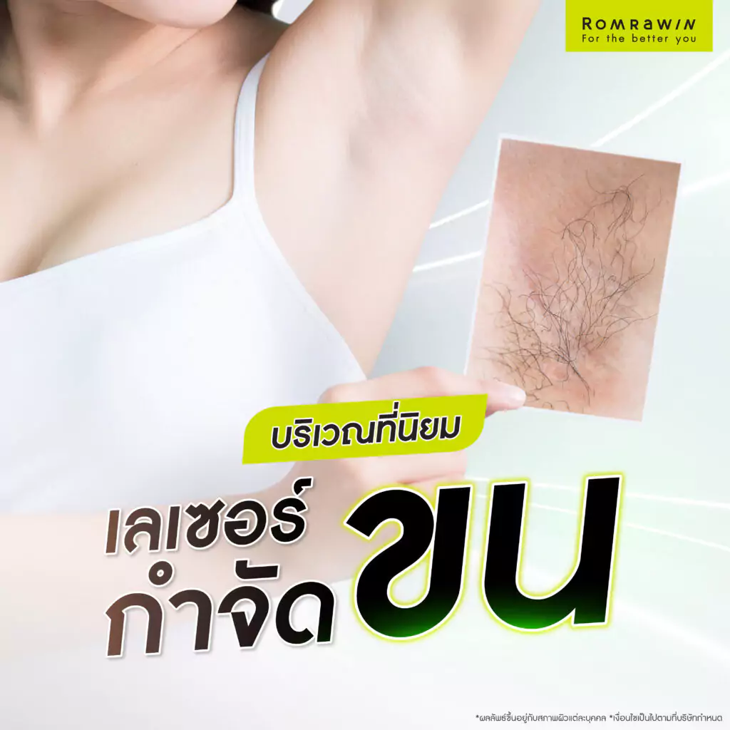 บริเวณที่นิยมทำเลเซอร์กำจัดขน