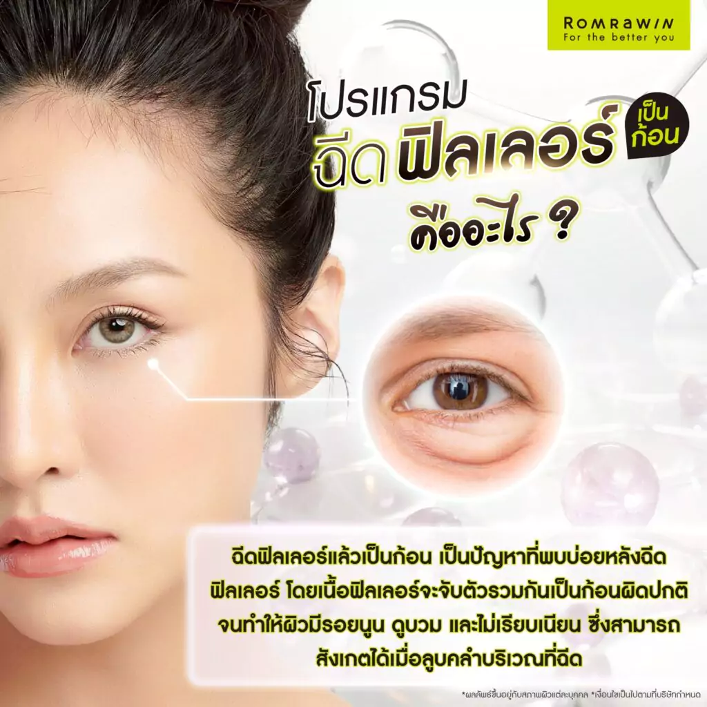 ฉีดฟิลเลอร์แล้วเป็นก้อน คืออะไร?