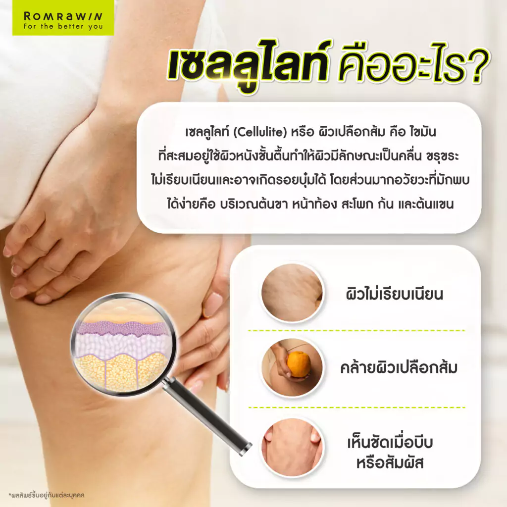 เซลลูไลท์ หรือผิวเปลือกส้ม คืออะไร?