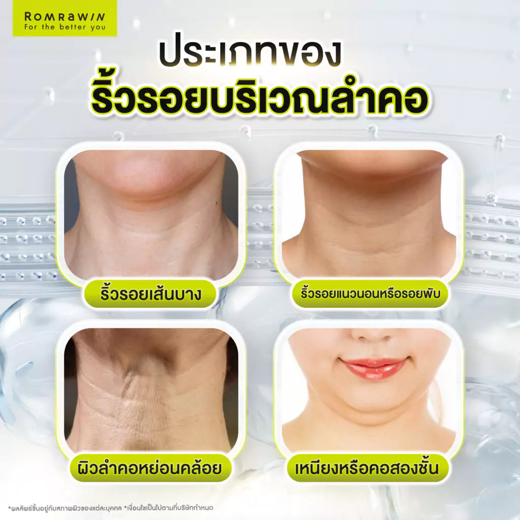 ประเภทของริ้วรอยและความหย่อนคล้อยของลำคอ