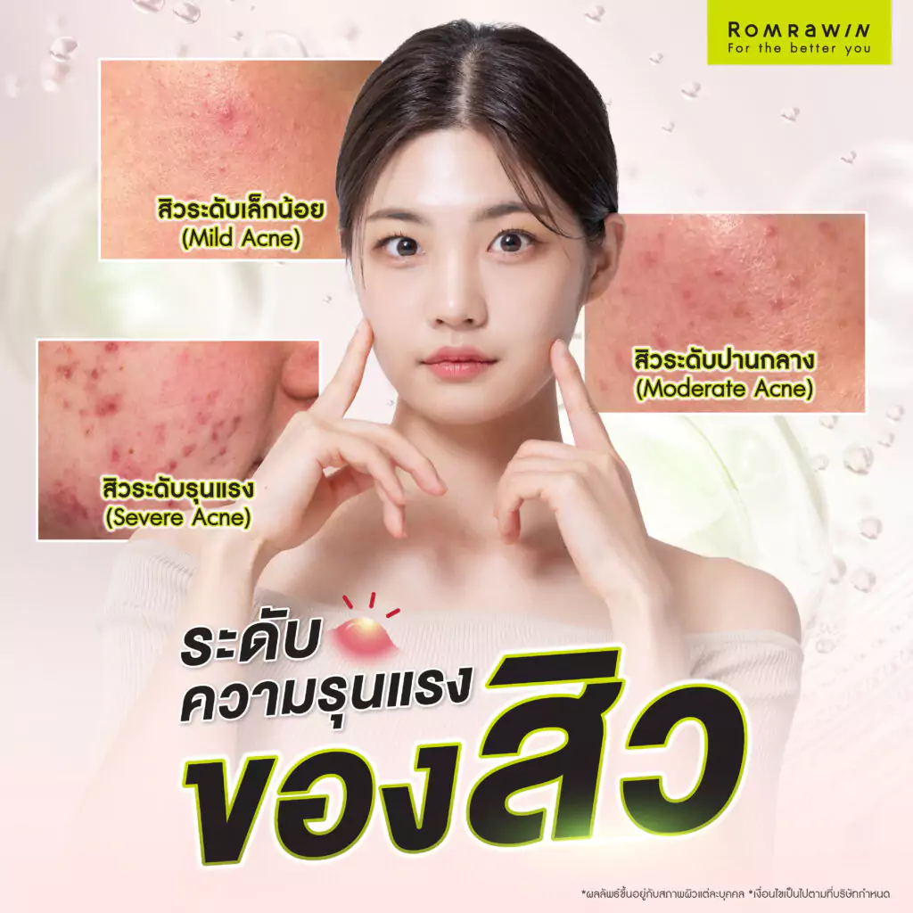 ระดับความรุนแรงของสิว รู้ไว้รักษาได้ไว อย่าปล่อยให้ลุกลาม