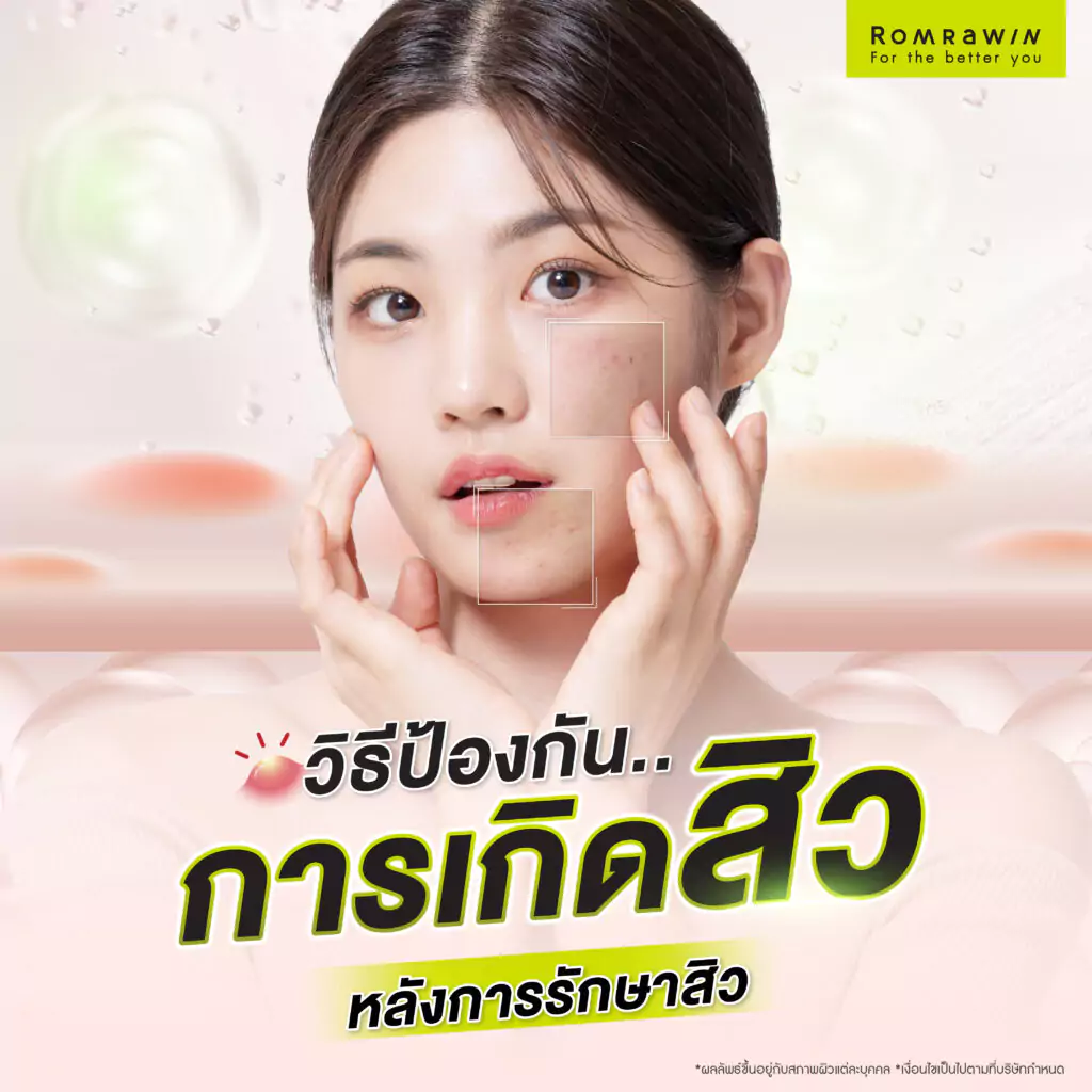 วิธีป้องกันการเกิดสิวหลังการรักษาสิว
