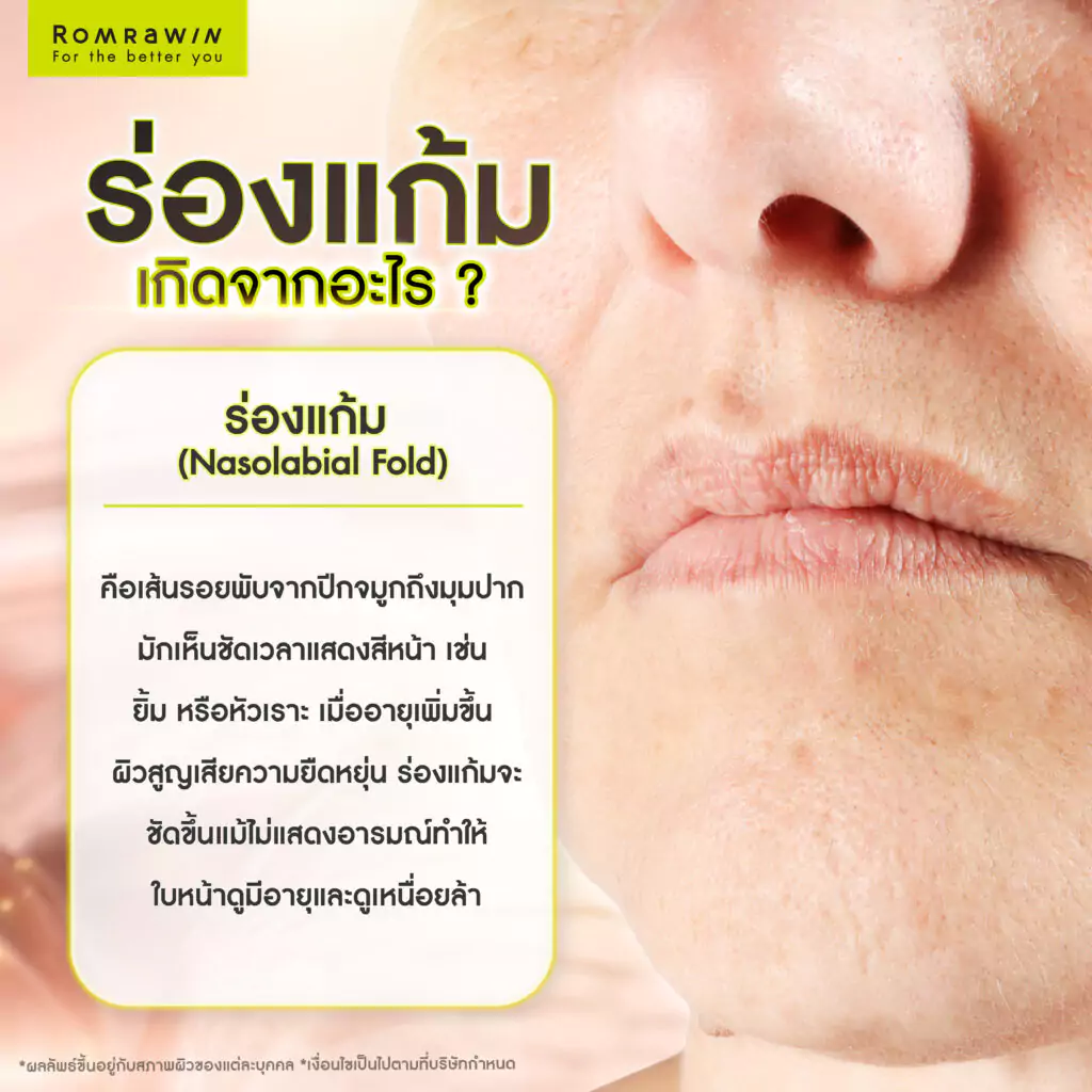 ร่องแก้มเกิดจากอะไร?