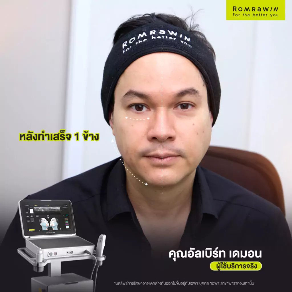 Ultherapy PRIME คุณอัลเบิร์ท เดมอน