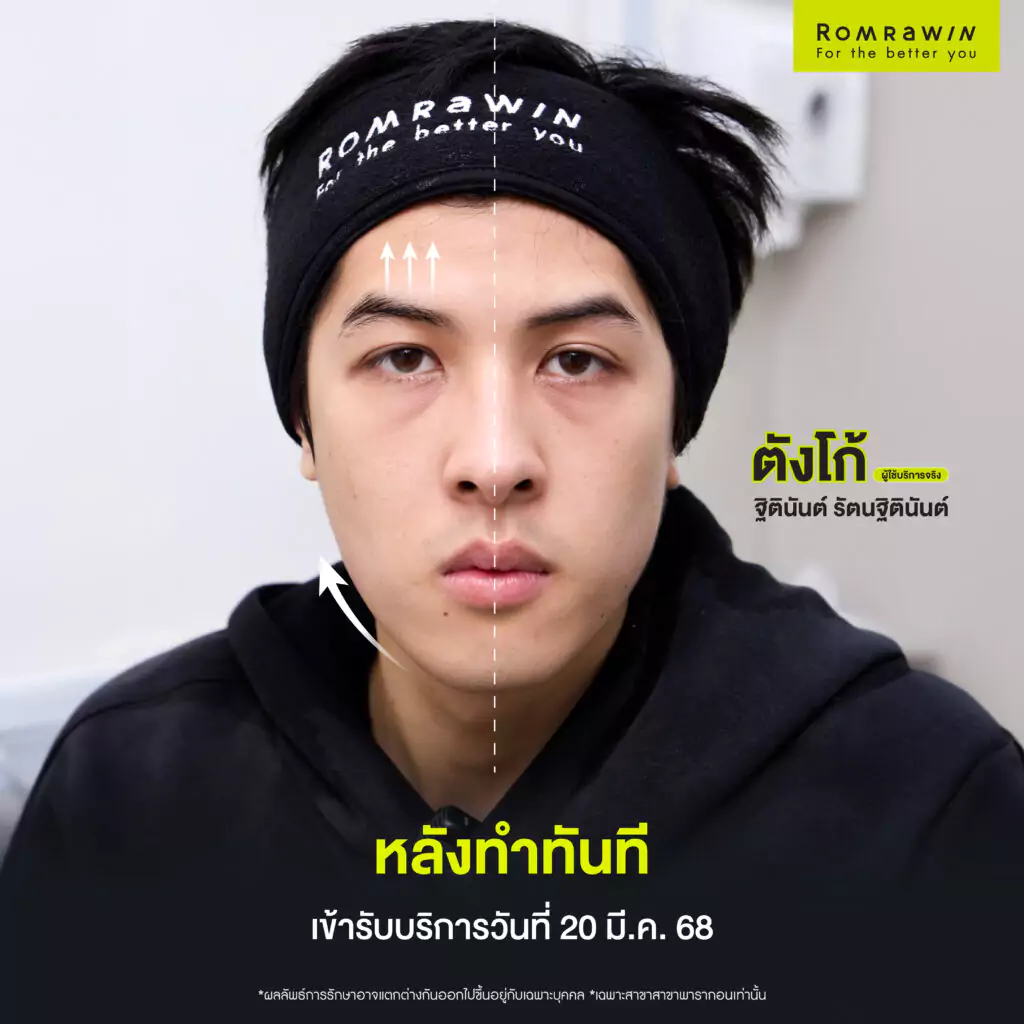 คุณตังโก้ Ultraformer MPT 4D LIFT กรอบหน้าชัดแบบผู้ชายสมัยใหม่ 