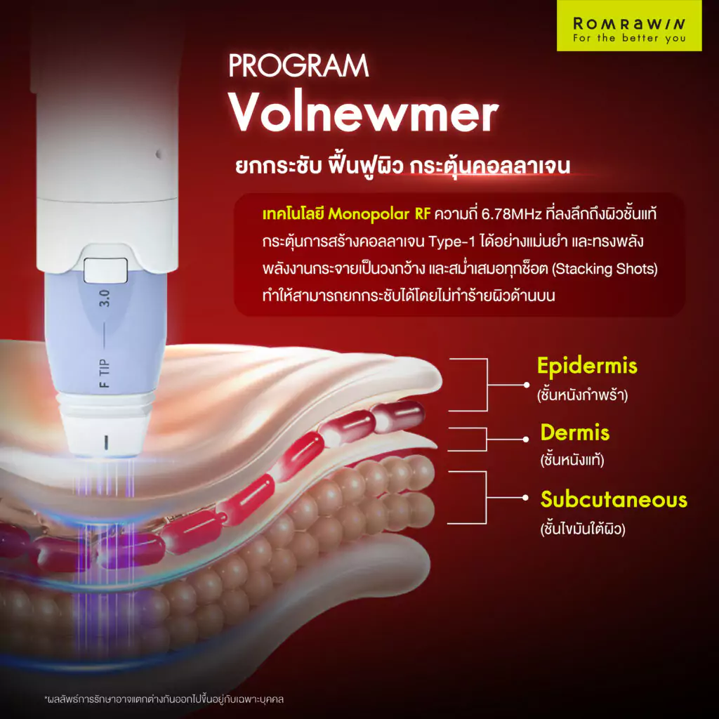 VOLNEWMER คืออะไร
