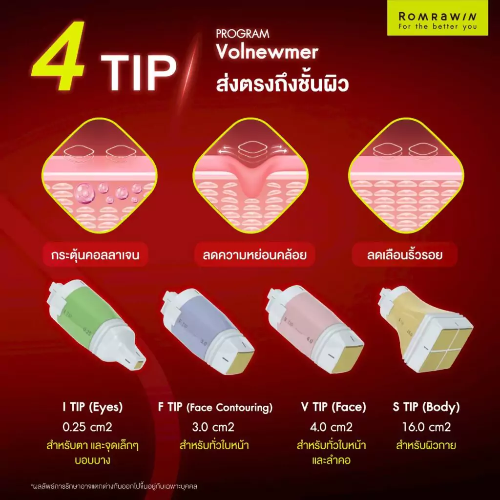 VOLNEWMER  มีหัวทิปให้เลือกถึง 4 ประเภท