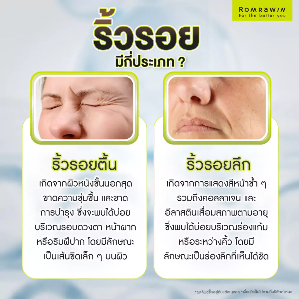ริ้วรอยมีกี่ประเภท?